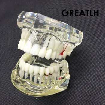 Модел на Зъбите зубоврачебного Изследвания Прозрачна за Възрастни Патологични Зъби е Подходяща за Обучение на Възрастни